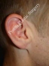 Earlobe Repair Surgery after 612298