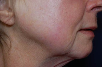 Total FX CO2 Laser after 564740
