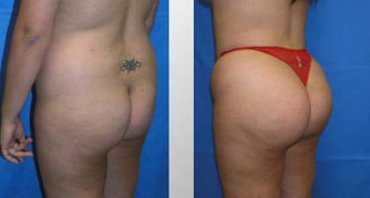 Butt Augmentation before 256436