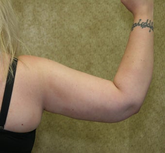 Brachioplasty or arm tuck 583681