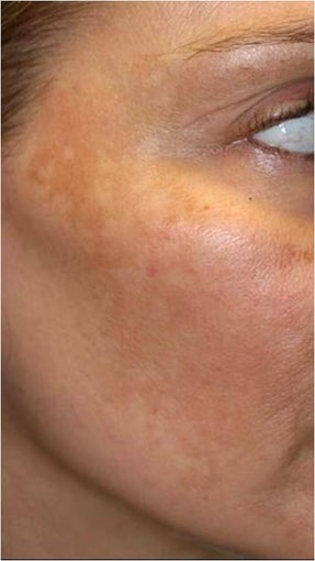 Fraxel - Melasma before 652382