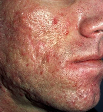 Acne Scarring before 157587