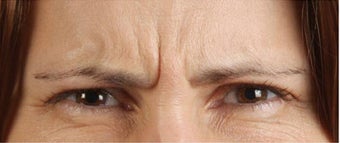 Botox before 391577