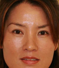 blepharoplasty (eyelids) before 219355