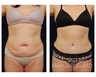 Abdominoplasty - Tummy Tuck before 396135