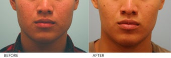 Botox Jaw Reduction before 236013