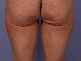 CoolSculpting to Banana Roll, Upper Posterior Thighs before 563822