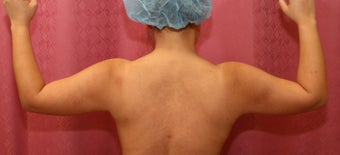 liposuction of arms for women 583554