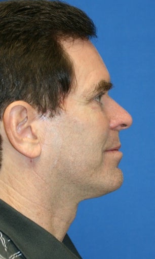 fat transfer after 238748