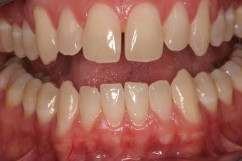 Porcelain Crowns before 332541