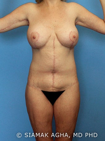 High-Definition™ Total Body Lift after 177430