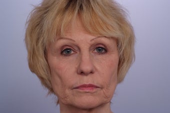 Laser Resurfacing before 253081