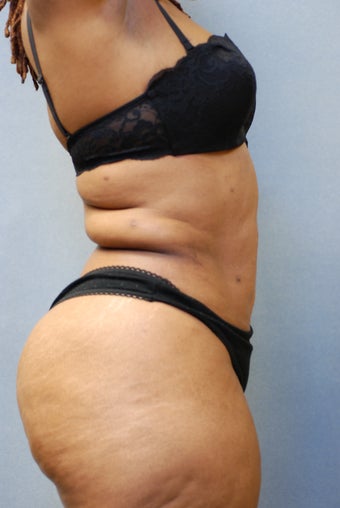 Wrap around Abs after 346572
