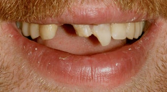 Trauma, Implants, Full Restoration before 389311