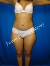 Liposuction before 633679