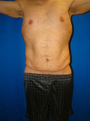 Male Tummy Tuck Surgery (abdominoplasty) Solana Beach, California before 131612