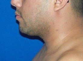 Laser Liposuction after 220264