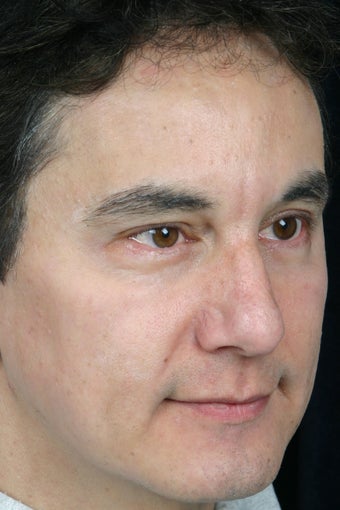 Pearl, Botox and Juvederm to Glabella (between eyes) 308344
