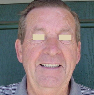 Dentures after 109193