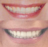 DaVinci porcelain veneers before 109166