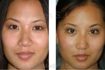 Eyelid before 427716