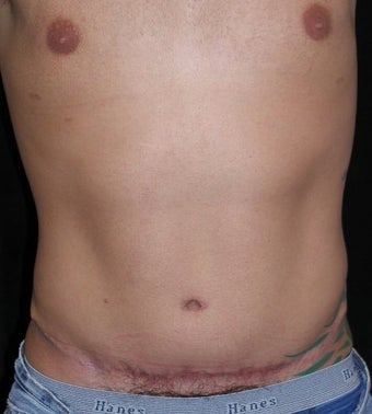 Male tummy Tuck, Flank Liposuction after 578199
