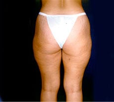 Smartlipo 401653