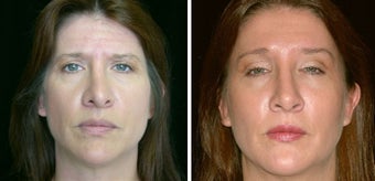 45 year old female, rhinoplasty before 629120