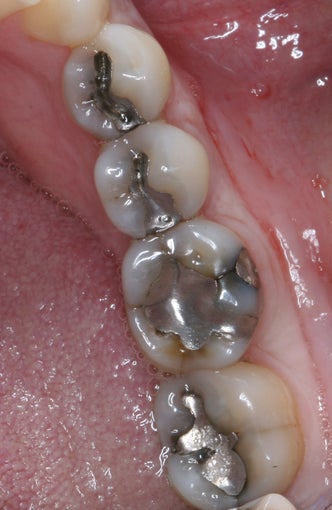 Mercury Silver filling replacement before 372798