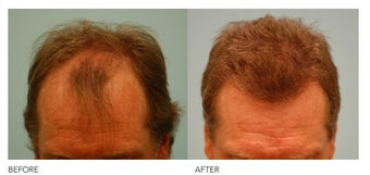 Hair Transplant before 133428