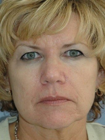 Botox and Fillers before 405385