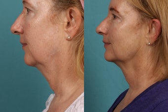 Ultherapy before 615721