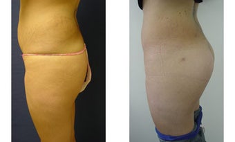 Buttocks Implants after 399986