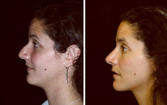 28 year old female, rhinoplasty before 629088