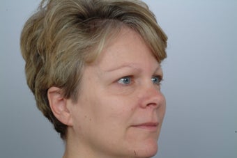 Endoscopic Brow Lift before 250451