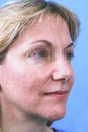 Fractional CO2 Laser Resurfacing before 114175