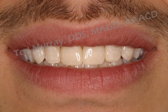 Direct Composite Resin Veneers after 346958