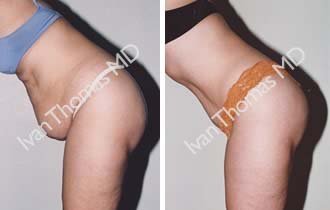 Tummy Tuck before 242530