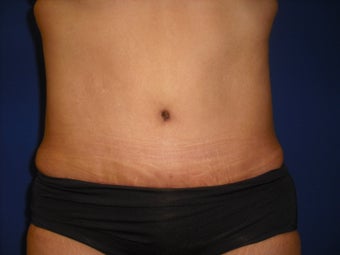 Tummy Tuck after 214629