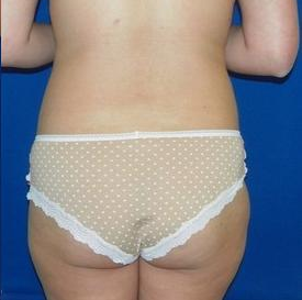 Laser Liposuction 220308
