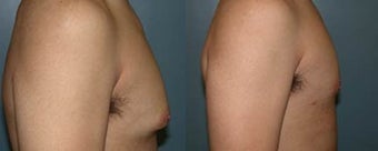 Gynecomastia (male breast reduction) before 96458