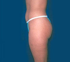 Smartlipo 401662