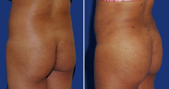 Brazilian Butt Lift after 494512