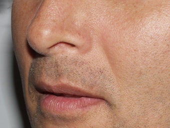 Lip Augmentation before 213005