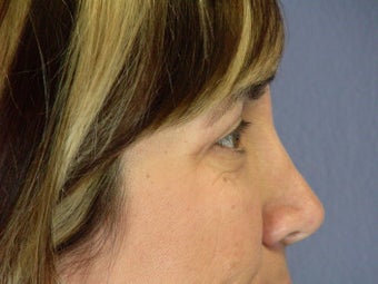 Eyelid Surgery after 306462
