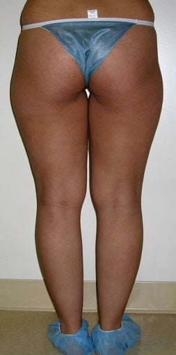 liposuction of thighs for women before 583569