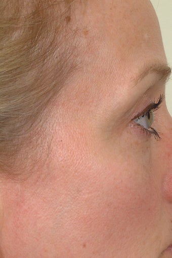Pearl Laser Treatment after 102785