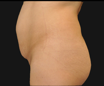 Andominoplasty before 458930
