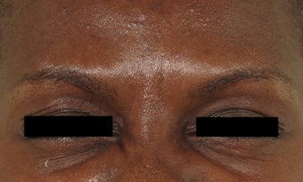 Botox after 378210