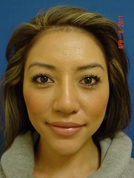 Chin Augmentation/Rhinoplasty after 393380